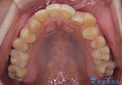 下顎の叢生を抜歯矯正で改善|費用を抑えたメタルブラケット矯正の治療前