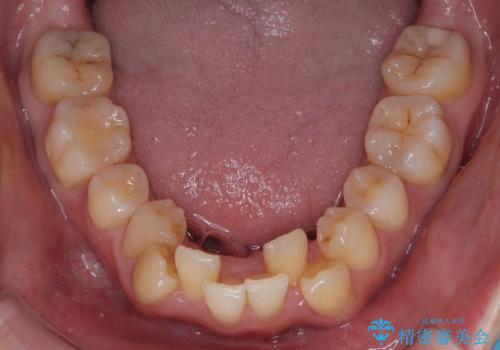 下顎の叢生を抜歯矯正で改善|費用を抑えたメタルブラケット矯正の治療前