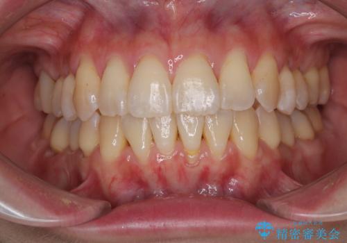 前歯のデコボコをインビザラインで目立たずに改善の治療後