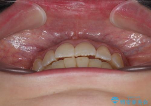 前歯のデコボコをインビザラインで目立たずに改善の治療後