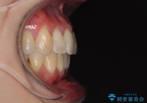 前歯のデコボコをインビザラインで目立たずに改善の治療後