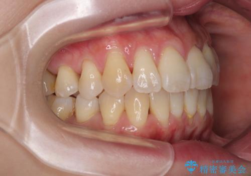 前歯のデコボコをインビザラインで目立たずに改善の治療後