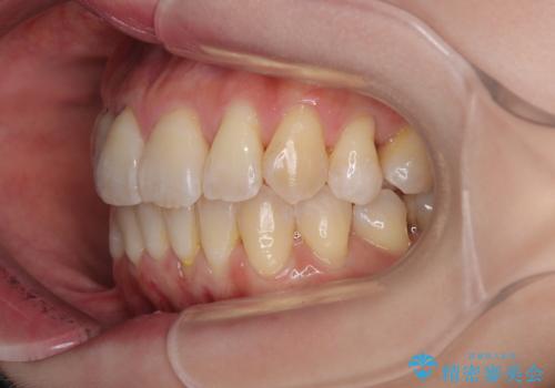 前歯のデコボコをインビザラインで目立たずに改善の治療後