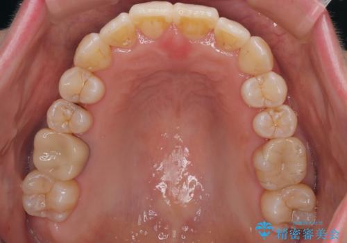 前歯のデコボコをインビザラインで目立たずに改善の治療後