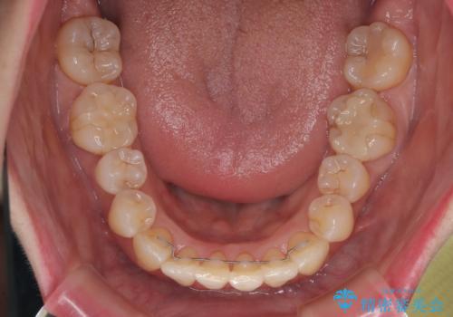 前歯のデコボコをインビザラインで目立たずに改善の治療後