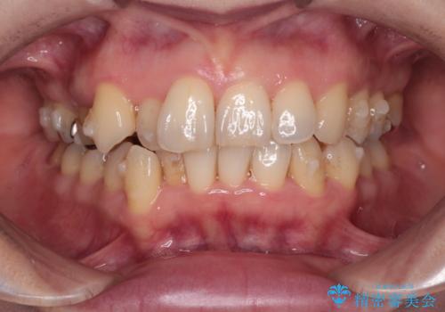 目立たないマウスピースで八重歯を解消。右上5番の抜歯スペースを活用したインビザライン矯正の治療中