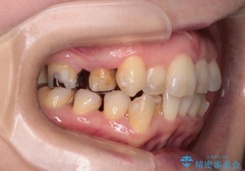 目立たないマウスピースで八重歯を解消。右上5番の抜歯スペースを活用したインビザライン矯正の治療中