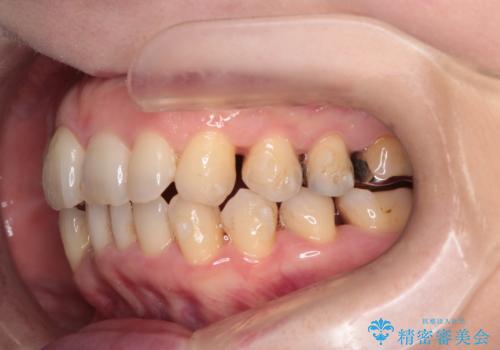 目立たないマウスピースで八重歯を解消。右上5番の抜歯スペースを活用したインビザライン矯正の治療中