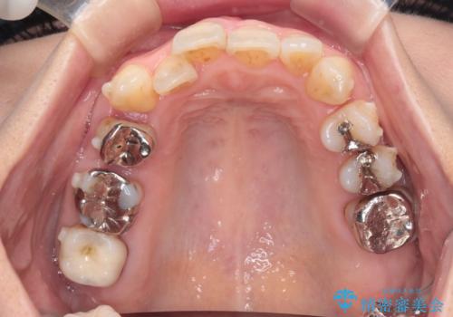 目立たないマウスピースで八重歯を解消。右上5番の抜歯スペースを活用したインビザライン矯正の治療中