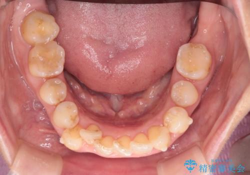 目立たないマウスピースで八重歯を解消。右上5番の抜歯スペースを活用したインビザライン矯正の治療中