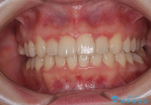 飛び出した前歯を引っ込める　ワイヤー装置の非抜歯矯正の症例 治療後