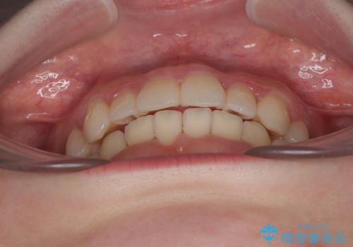 飛び出した前歯を引っ込める ワイヤー装置の非抜歯矯正の治療後