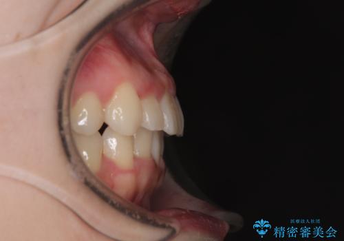 飛び出した前歯を引っ込める ワイヤー装置の非抜歯矯正の治療後