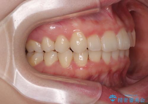 飛び出した前歯を引っ込める ワイヤー装置の非抜歯矯正の治療後