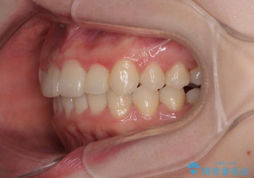 飛び出した前歯を引っ込める ワイヤー装置の非抜歯矯正の治療後