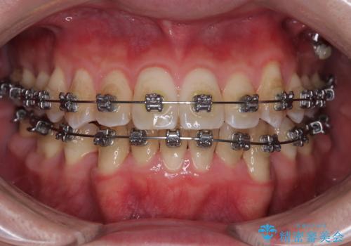 下顎の叢生を抜歯矯正で改善|費用を抑えたメタルブラケット矯正の治療中