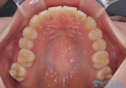 飛び出した前歯を引っ込める ワイヤー装置の非抜歯矯正の治療後