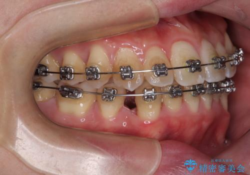 下顎の叢生を抜歯矯正で改善|費用を抑えたメタルブラケット矯正の治療中
