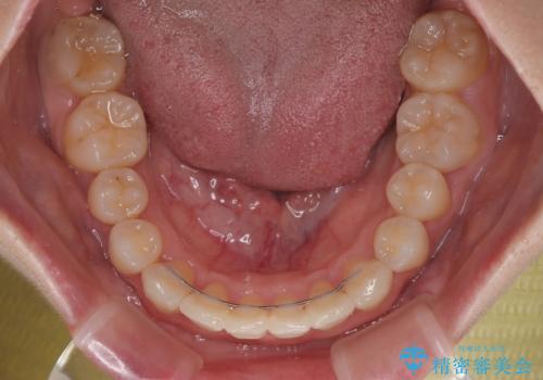 飛び出した前歯を引っ込める ワイヤー装置の非抜歯矯正の治療後