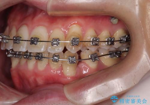 下顎の叢生を抜歯矯正で改善|費用を抑えたメタルブラケット矯正の治療中