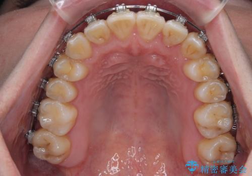 下顎の叢生を抜歯矯正で改善|費用を抑えたメタルブラケット矯正の治療中