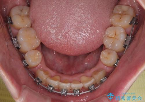 下顎の叢生を抜歯矯正で改善|費用を抑えたメタルブラケット矯正の治療中