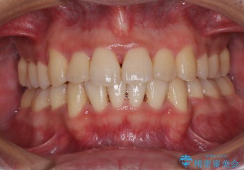 矯正治療途中で転院　遠方への転勤で通院困難な方の矯正治療の治療後