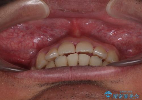 矯正治療途中で転院　遠方への転勤で通院困難な方の矯正治療の治療後