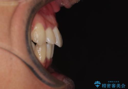 矯正治療途中で転院　遠方への転勤で通院困難な方の矯正治療の治療後