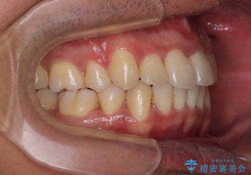 矯正治療途中で転院　遠方への転勤で通院困難な方の矯正治療の治療後