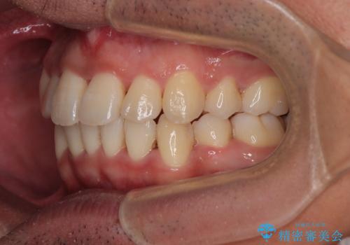 矯正治療途中で転院　遠方への転勤で通院困難な方の矯正治療の治療後