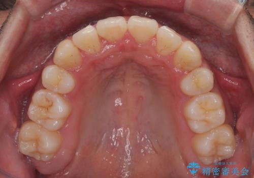 矯正治療途中で転院　遠方への転勤で通院困難な方の矯正治療の治療後