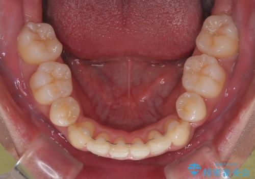 矯正治療途中で転院　遠方への転勤で通院困難な方の矯正治療の治療後
