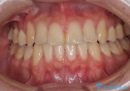 矯正治療の後戻り　インビザライン・モデレートパッケージで短期間治療の治療後