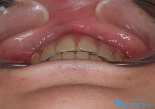 矯正治療の後戻り インビザライン・モデレートパッケージで短期間治療の治療後