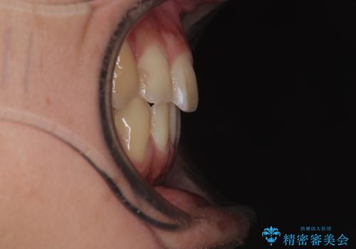 矯正治療の後戻り インビザライン・モデレートパッケージで短期間治療の治療後