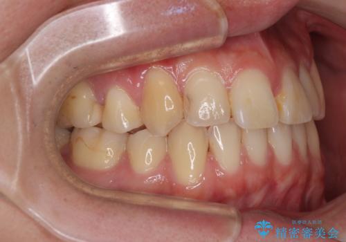 矯正治療の後戻り インビザライン・モデレートパッケージで短期間治療の治療後