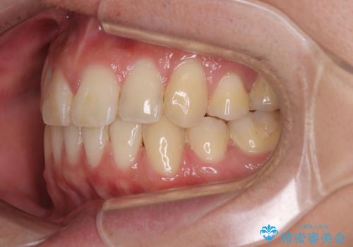 矯正治療の後戻り　インビザライン・モデレートパッケージで短期間治療の治療後