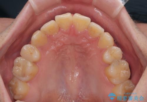 矯正治療の後戻り　インビザライン・モデレートパッケージで短期間治療の治療後