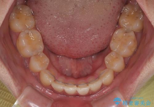 矯正治療の後戻り　インビザライン・モデレートパッケージで短期間治療の治療後