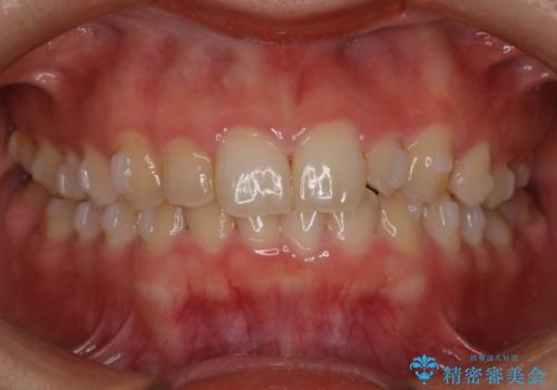 【インビザライン】がたつきを綺麗にしたいの治療中