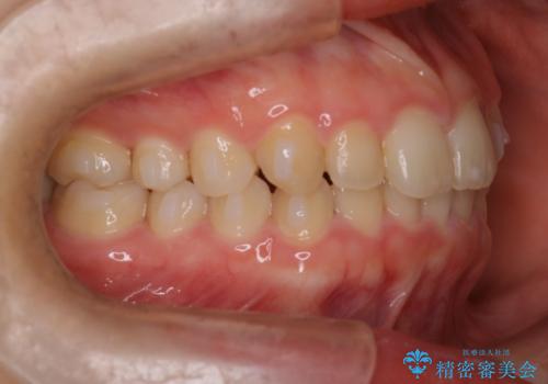 【インビザライン】がたつきを綺麗にしたいの治療中