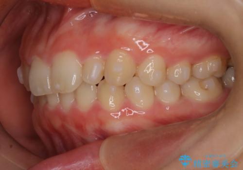 【インビザライン】がたつきを綺麗にしたいの治療中