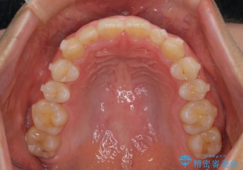 【インビザライン】がたつきを綺麗にしたいの治療中