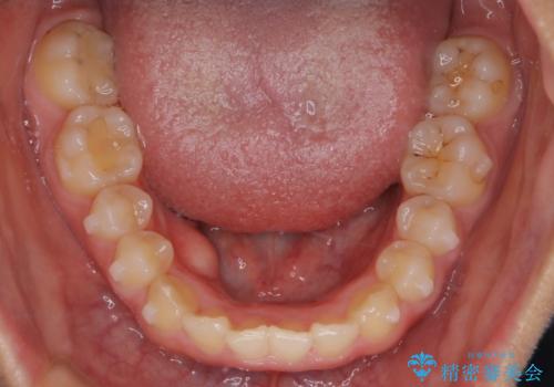 【インビザライン】がたつきを綺麗にしたいの治療中