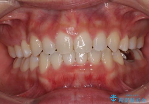 口ゴボが気になる 上下4本の抜歯矯正の治療後