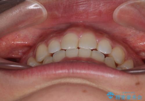 口ゴボが気になる　上下4本の抜歯矯正の治療後