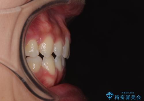 口ゴボが気になる　上下4本の抜歯矯正の治療後