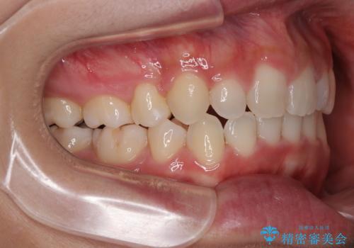 口ゴボが気になる　上下4本の抜歯矯正の治療後