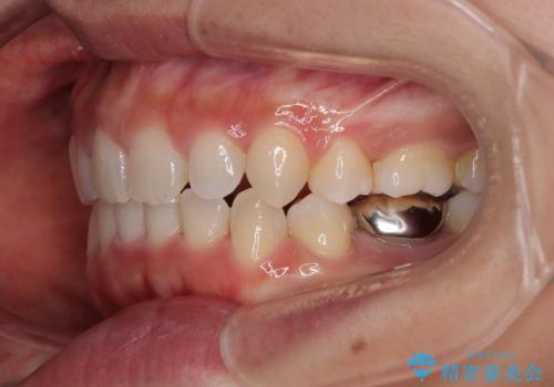 口ゴボが気になる　上下4本の抜歯矯正の治療後